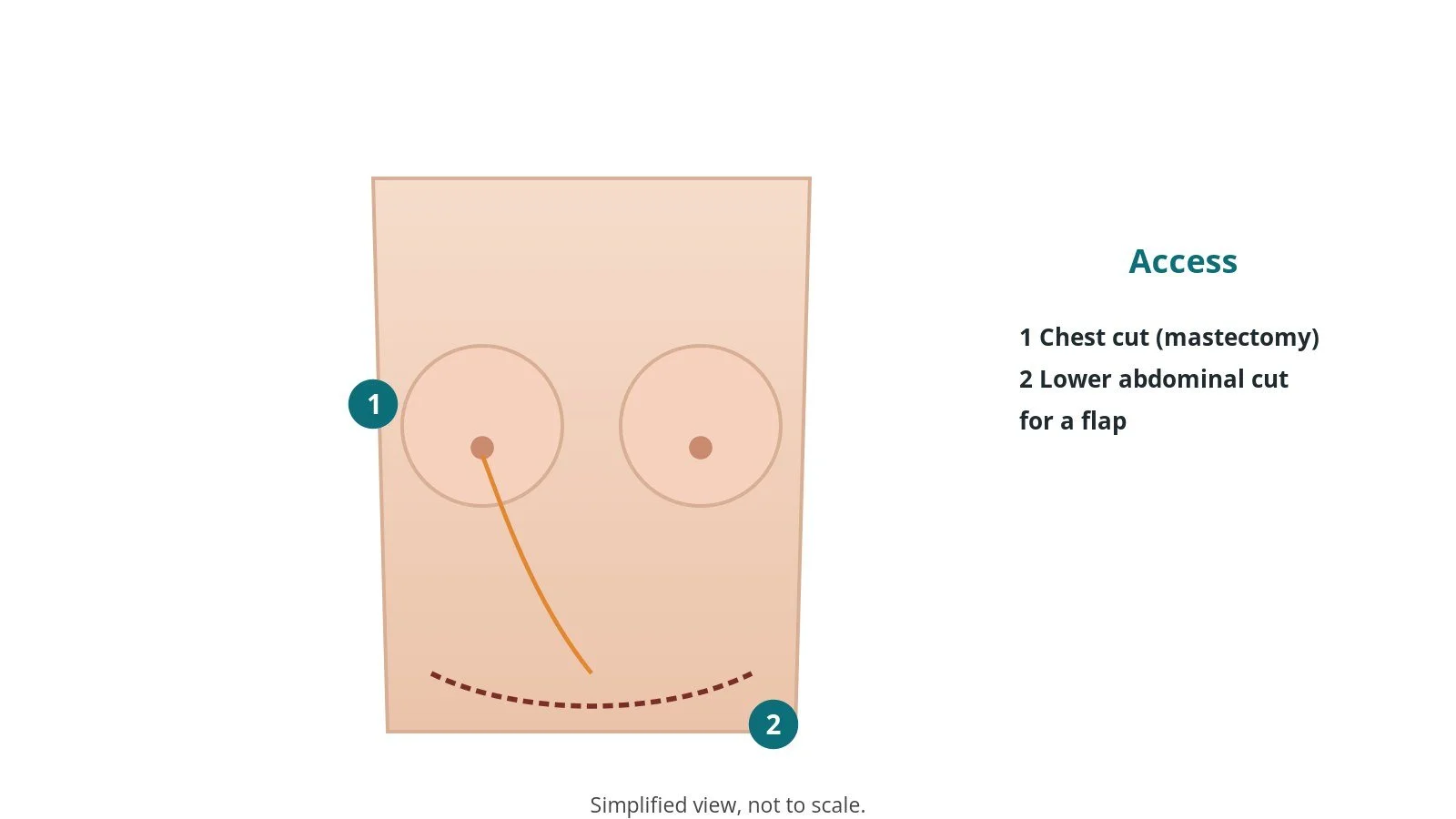 Diagram of the chest after mastectomy on one side with a dashed lower abdominal flap line