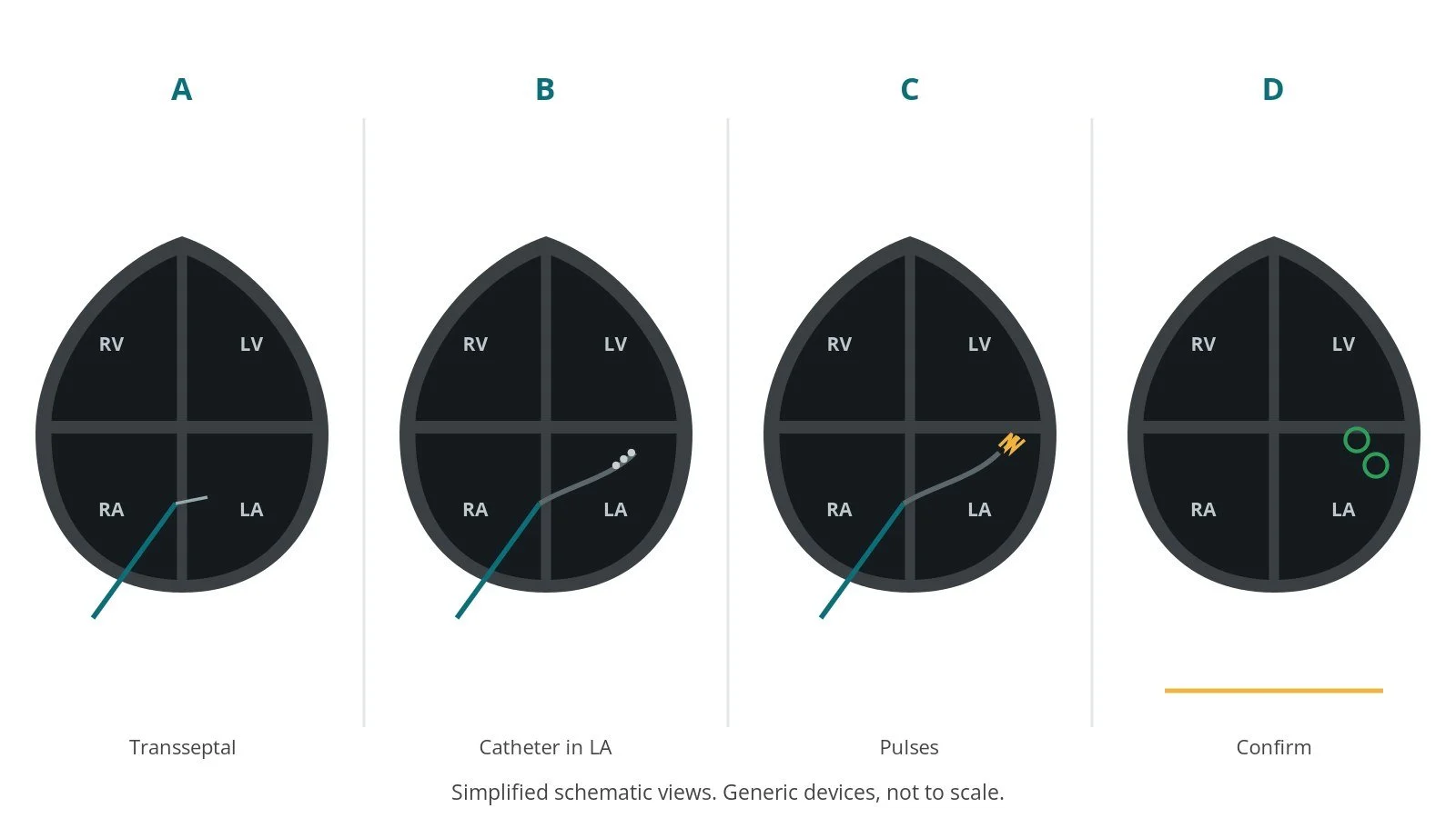 Four-panel schematic of pulsed field ablation: transseptal, catheter in la, pulses, confirm