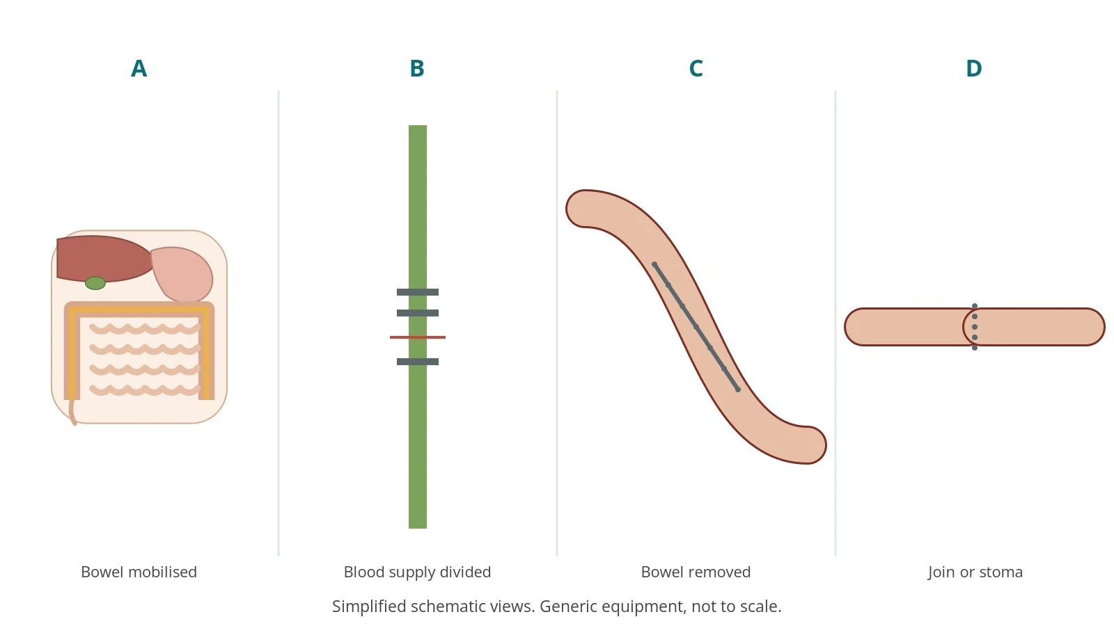 Four-panel schematic of colectomy: bowel mobilised, blood supply divided, bowel removed, join or stoma