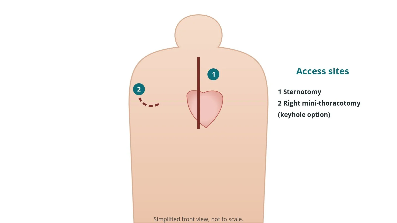 Front view of a patient showing a breastbone incision and an alternative small incision on the right side of the chest for mitral valve surgery