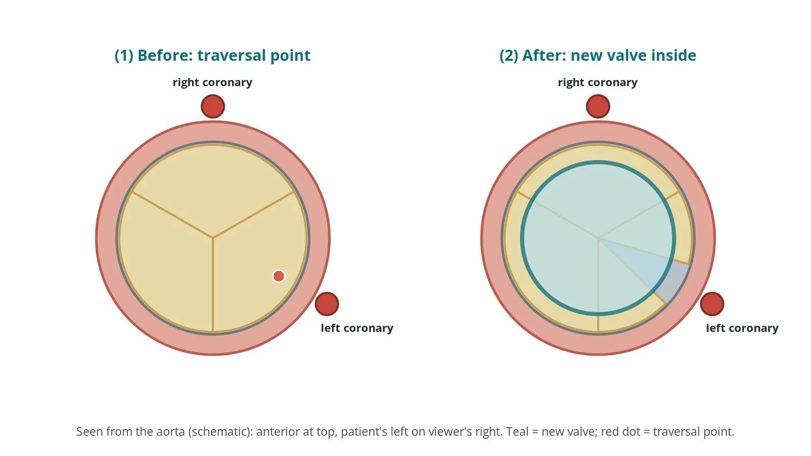 View of the old valve from above before and after UNICORN: three intact leaflets with a traversal point on the leaflet in front of the left coronary, then a new valve ring inside with that leaflet split open