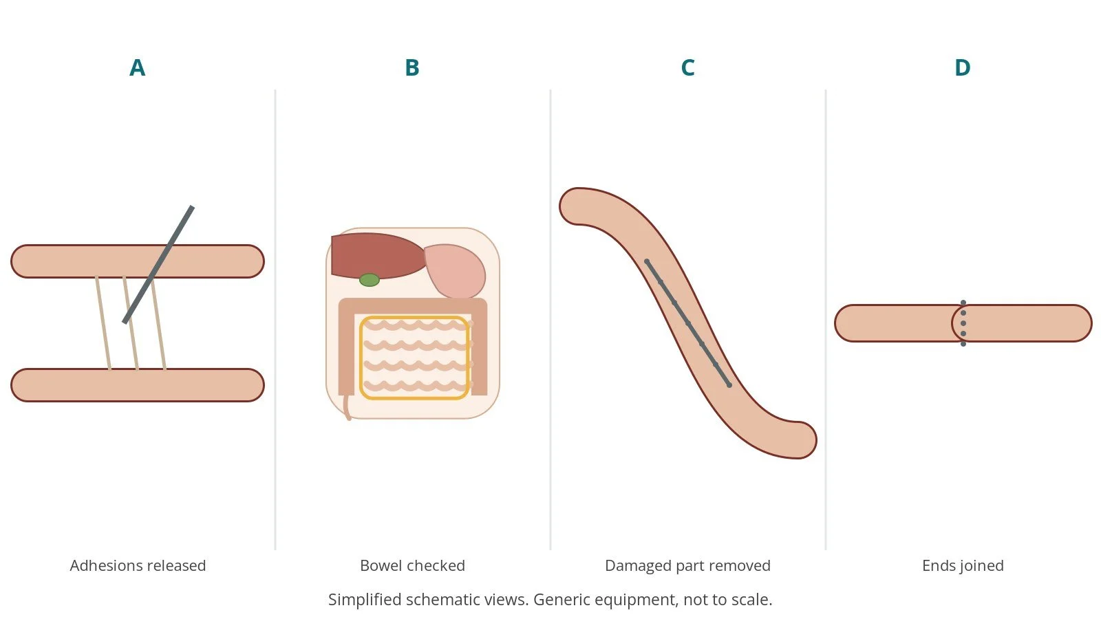 Four-panel schematic of small bowel resection or adhesiolysis: adhesions released, bowel checked, damaged part removed, ends joined