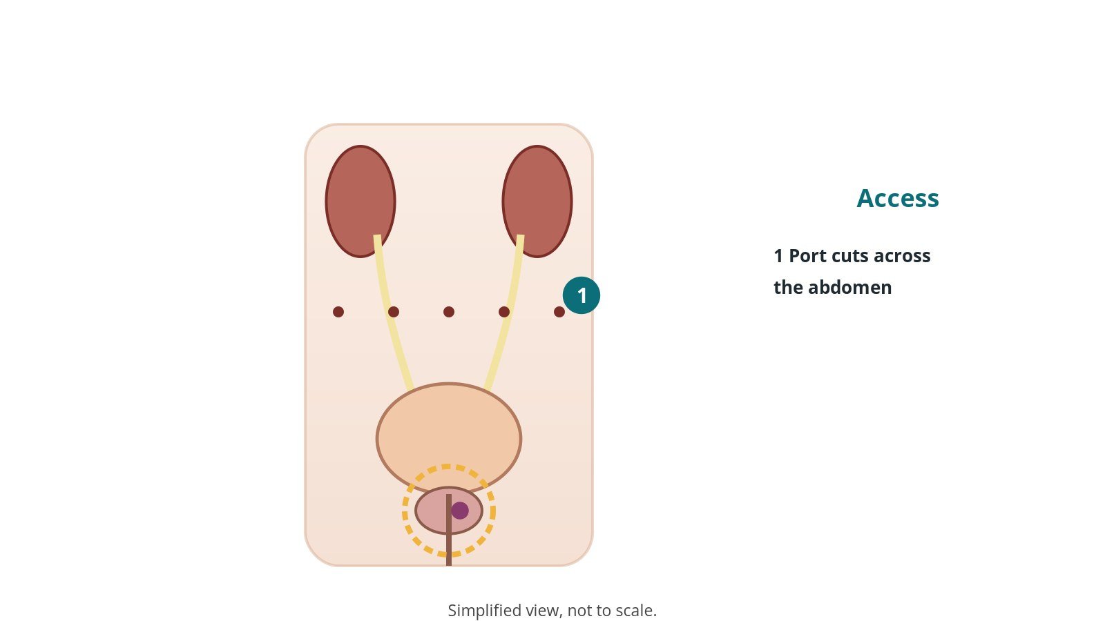 Diagram of the urinary tract with a row of keyhole port sites across the abdomen and the prostate ringed