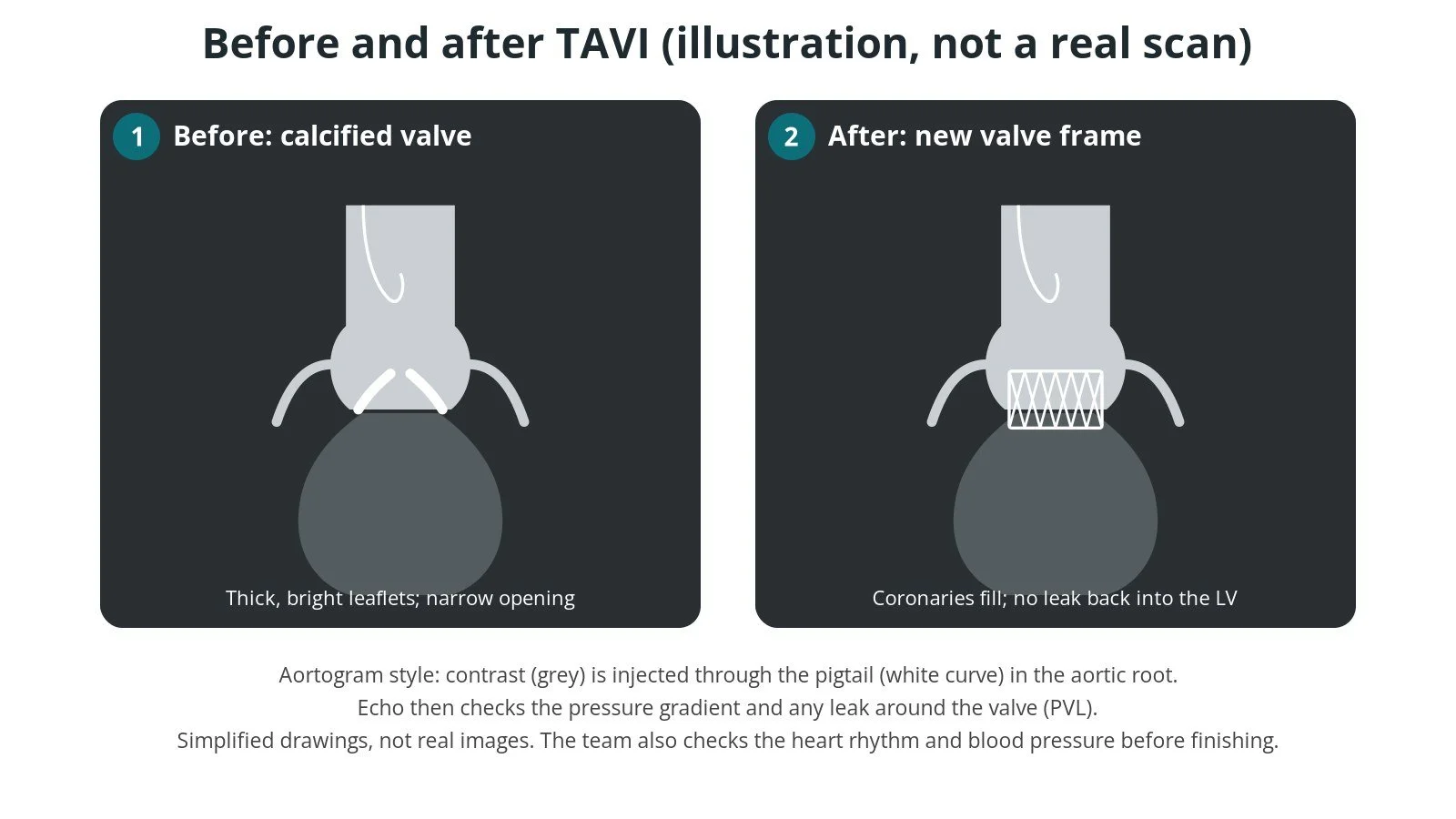 Illustrated aortogram before and after TAVI: before, a calcified narrow valve; after, a new valve frame in place with the coronary arteries filling and no leak back into the left ventricle