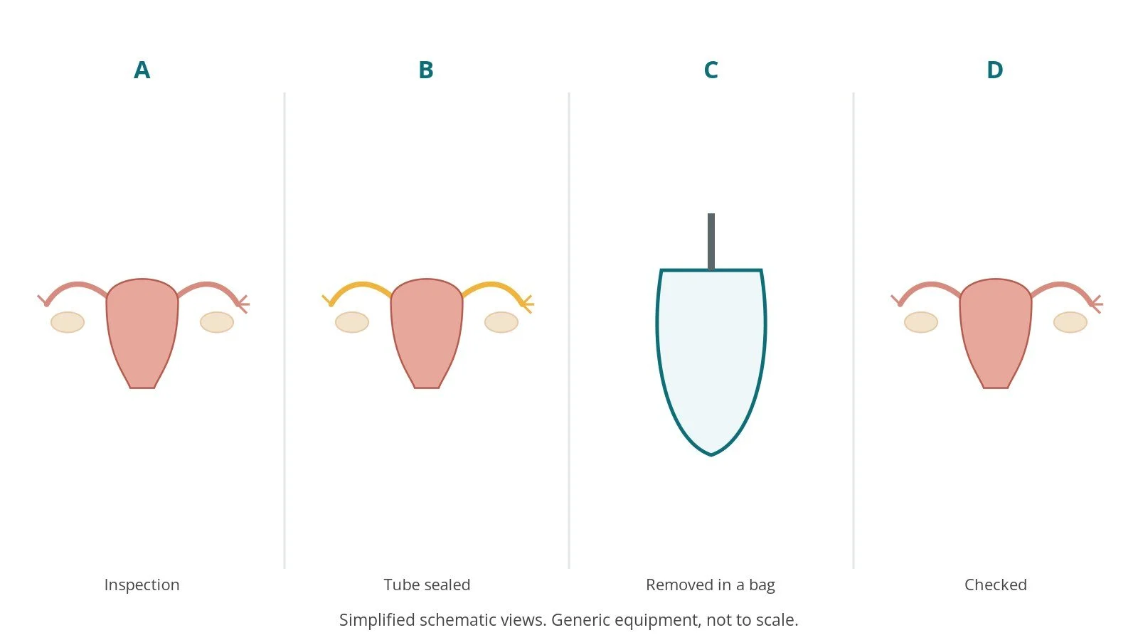 Four-panel schematic of salpingectomy or BSO: inspection, tube sealed, removed in a bag, checked