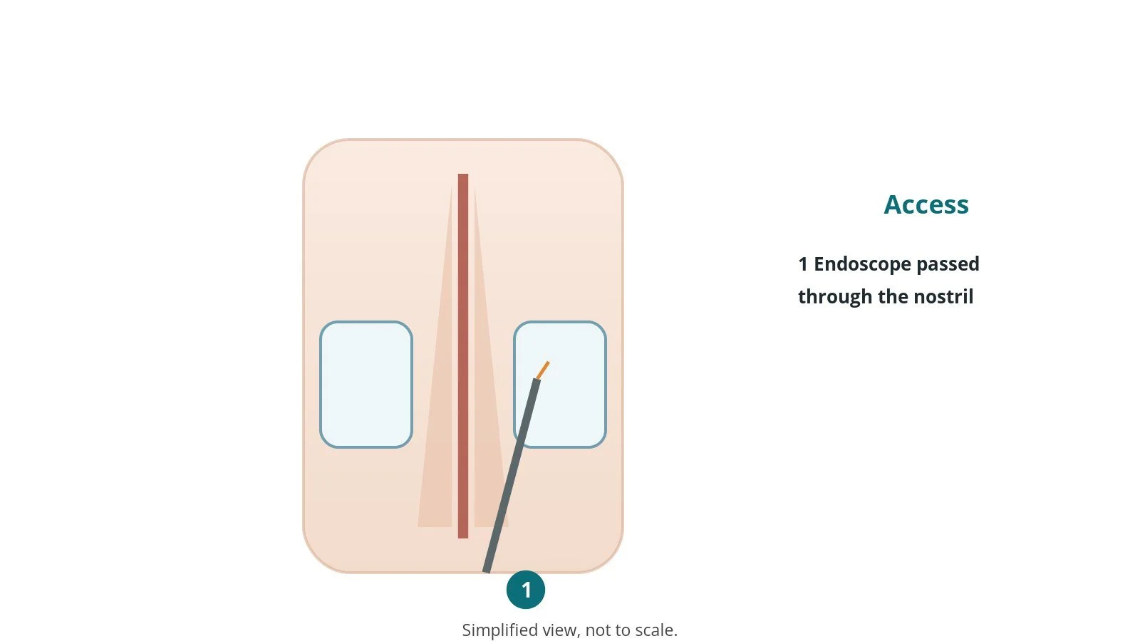 Diagram of the nose and sinuses from the front with an endoscope passed through the nostril