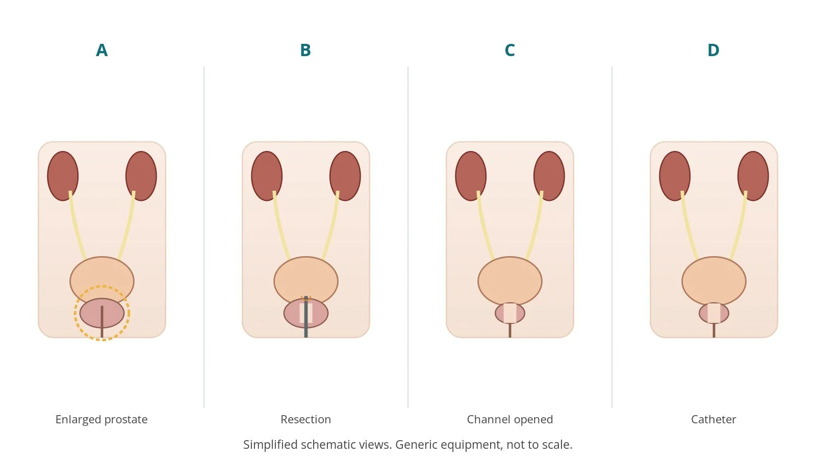 Four-panel schematic of TURP: enlarged prostate, resection, channel opened, catheter