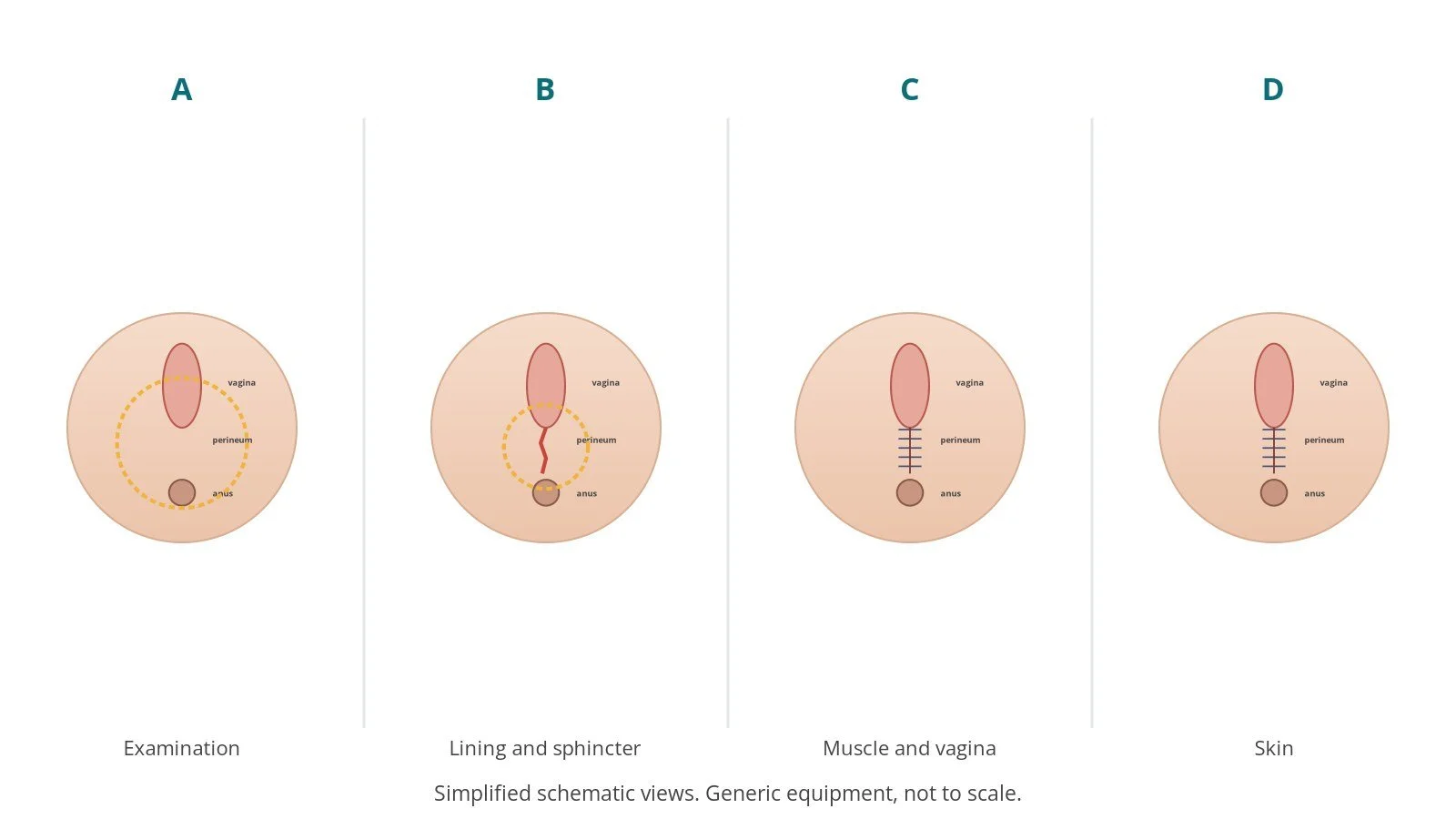 Four-panel schematic of perineal repair: examination, lining and sphincter, muscle and vagina, skin