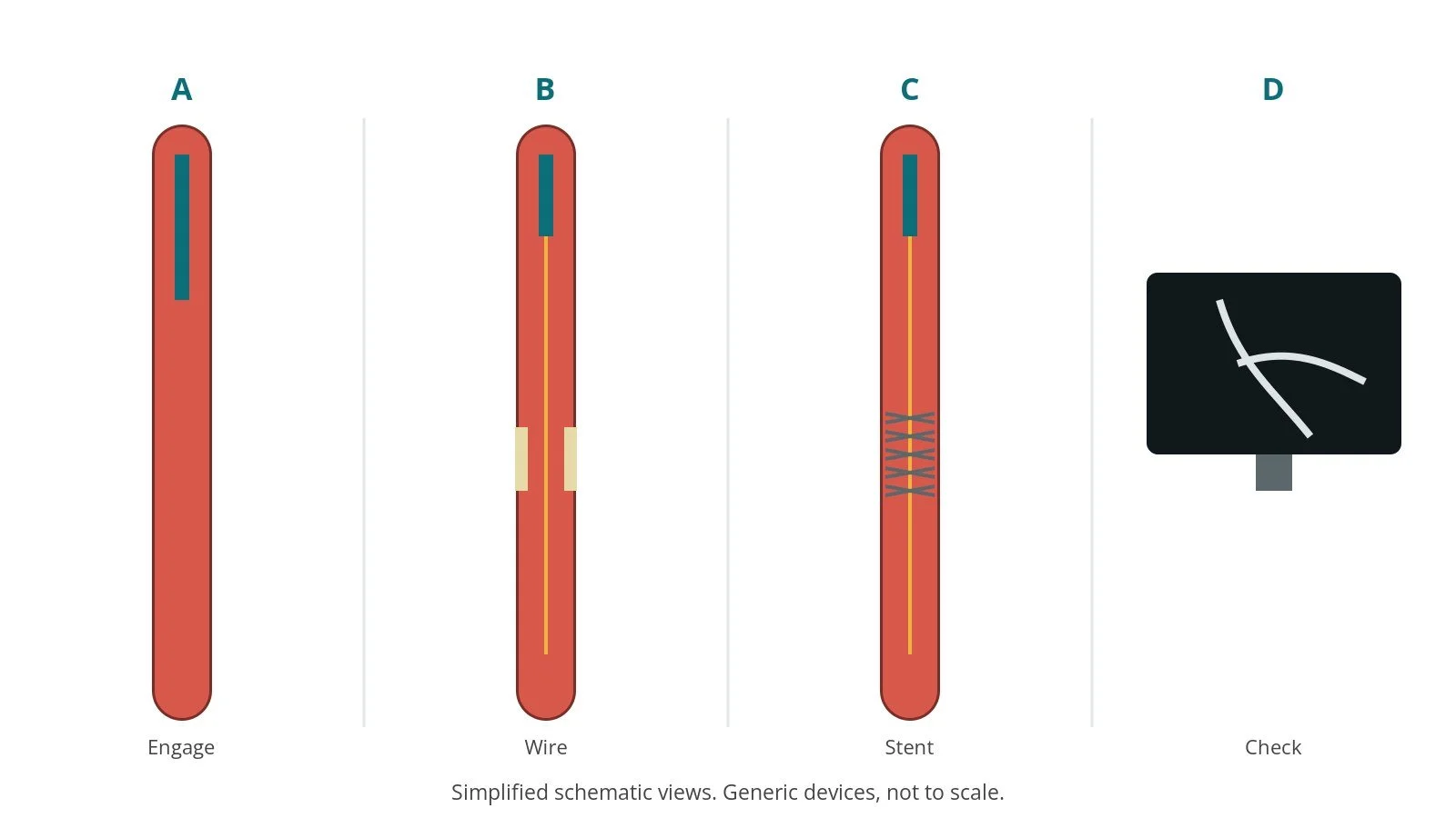 Four-panel schematic of renal artery stenting: engage, wire, stent, check