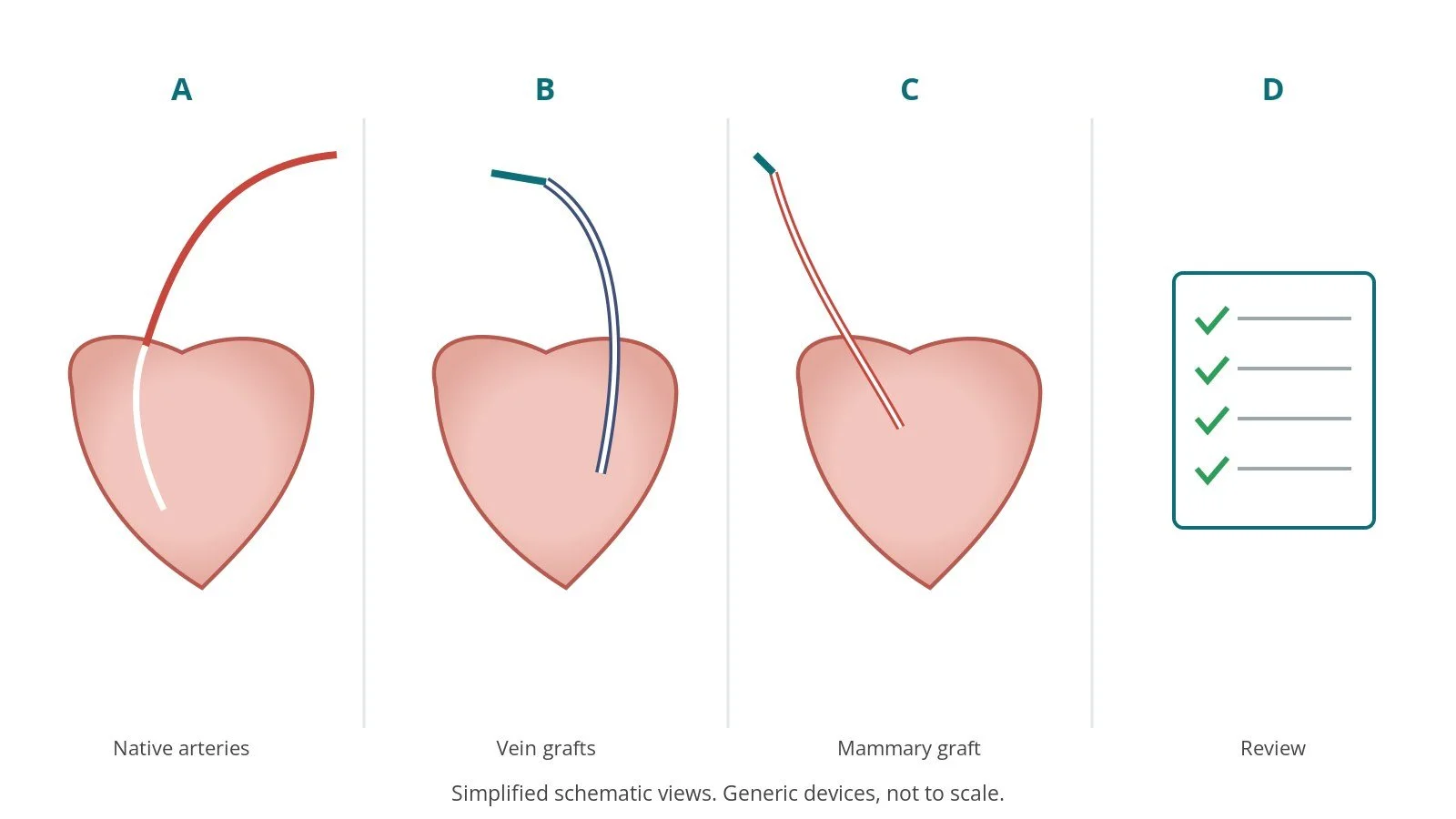 Four-panel schematic of bypass graft angiography: native arteries, vein grafts, mammary graft, review