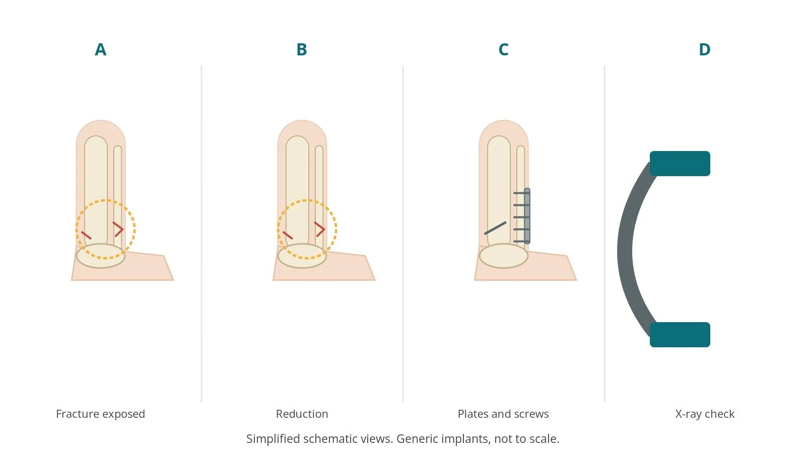 Four-panel schematic of ankle ORIF: fracture exposed, reduction, plates and screws, x-ray check