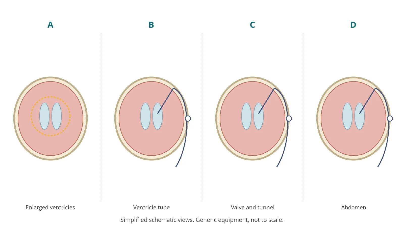 Four-panel schematic of VP shunt: enlarged ventricles, ventricle tube, valve and tunnel, abdomen