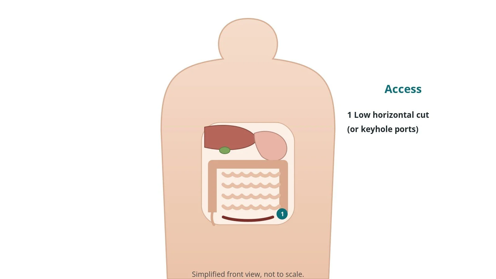 Front view of the abdomen showing a low horizontal incision just above the pubic hairline