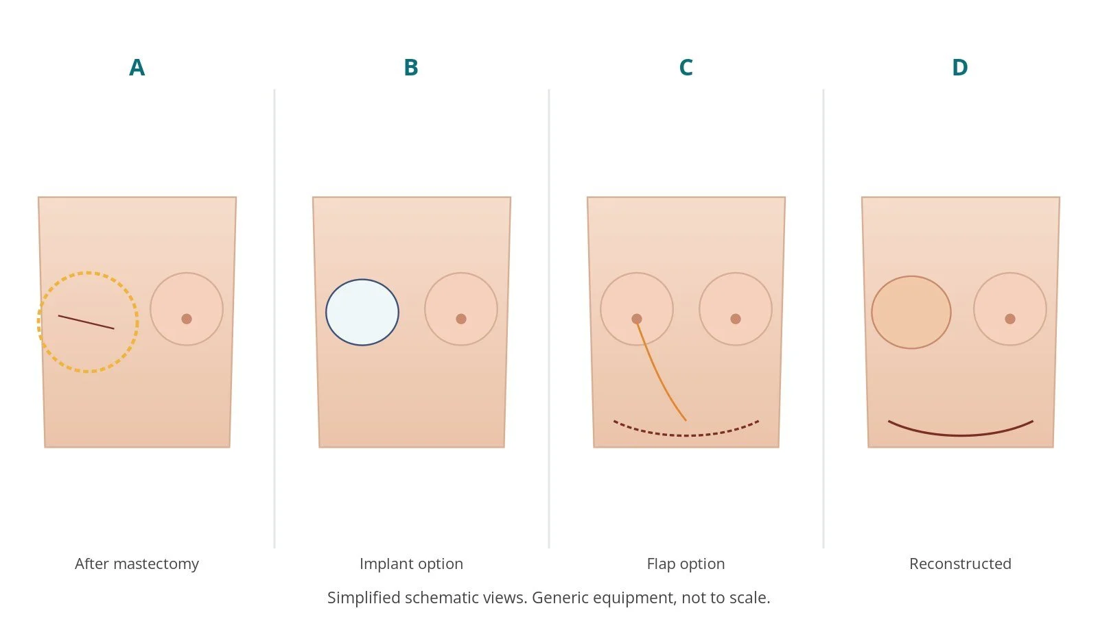 Four-panel schematic of breast reconstruction: after mastectomy, implant option, flap option, reconstructed