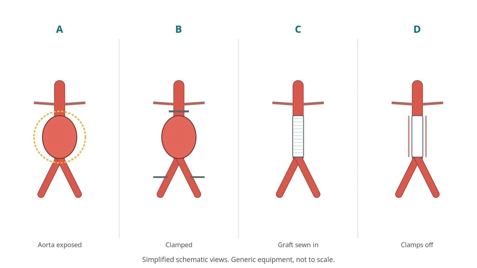 Four-panel schematic of open AAA repair: aorta exposed, clamped, graft sewn in, clamps off