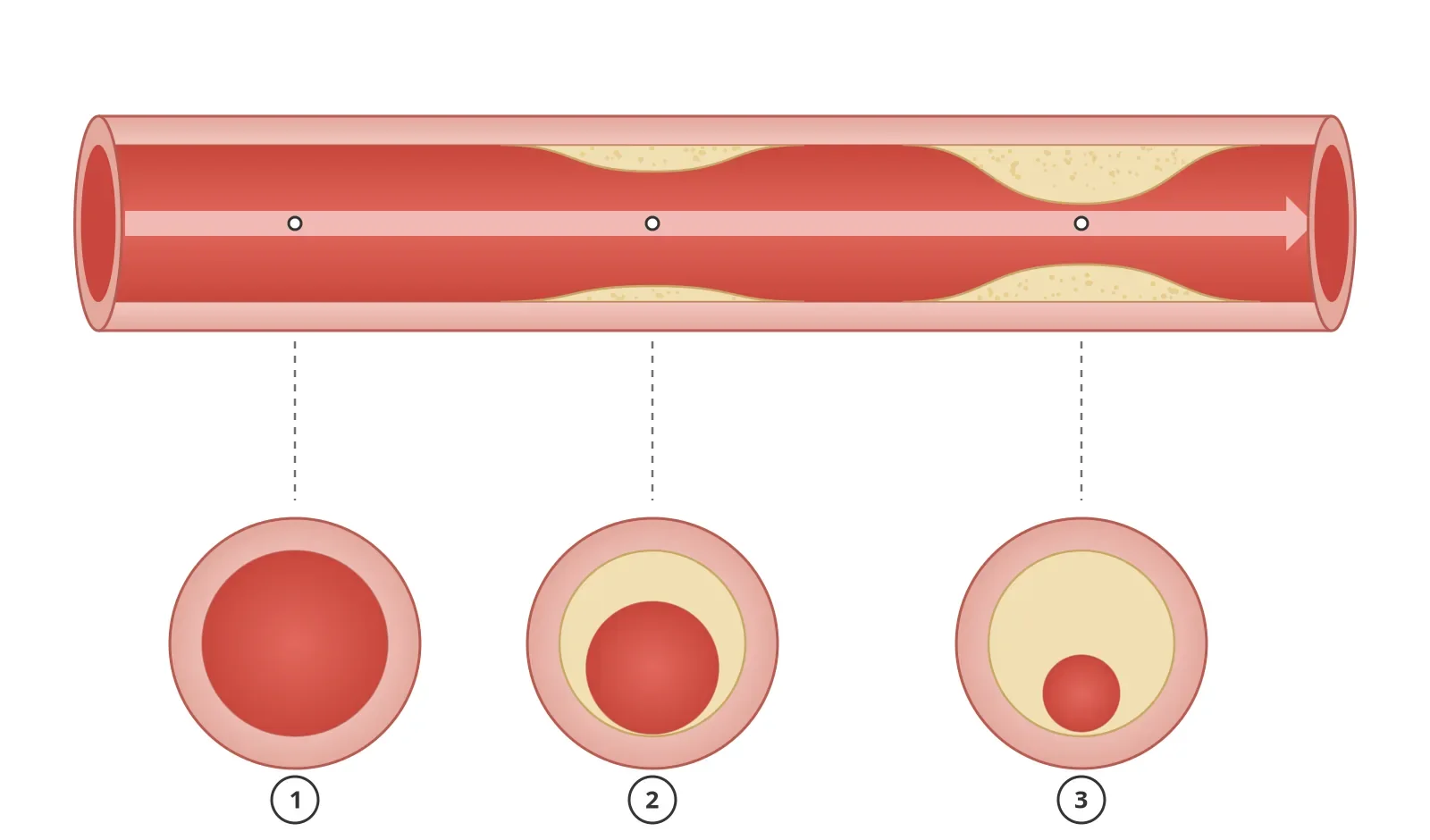 Diagram of plaque narrowing a coronary artery, a cause of angina