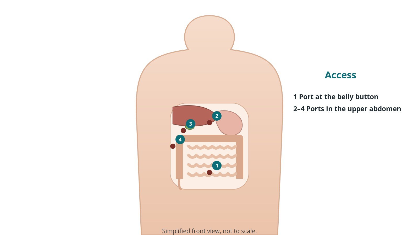 Front view of a patient showing four small port sites: one at the belly button and three in the upper abdomen