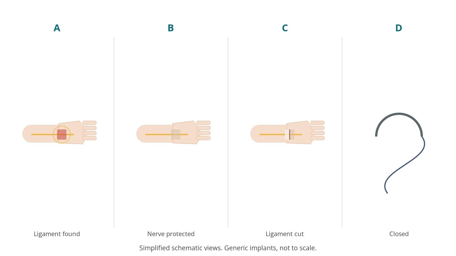 Four-panel schematic of carpal tunnel release: ligament found, nerve protected, ligament cut, closed