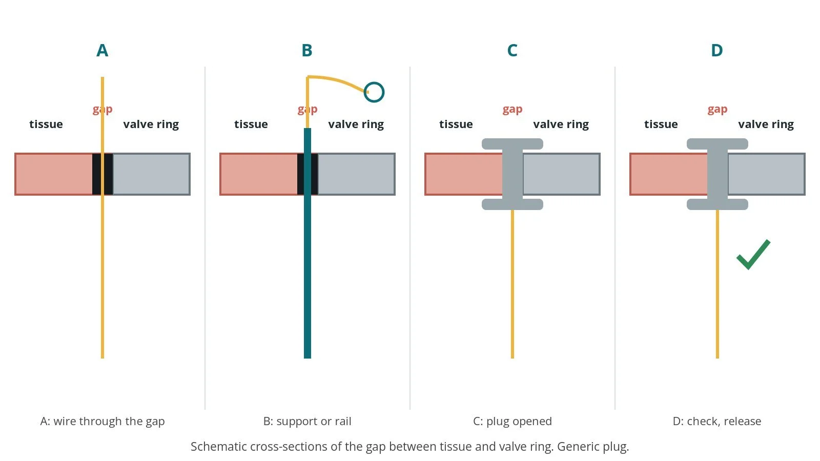 Four-panel diagram of PVL closure: wire crossing the gap, a support rail, the plug opened in the gap, and an echo check