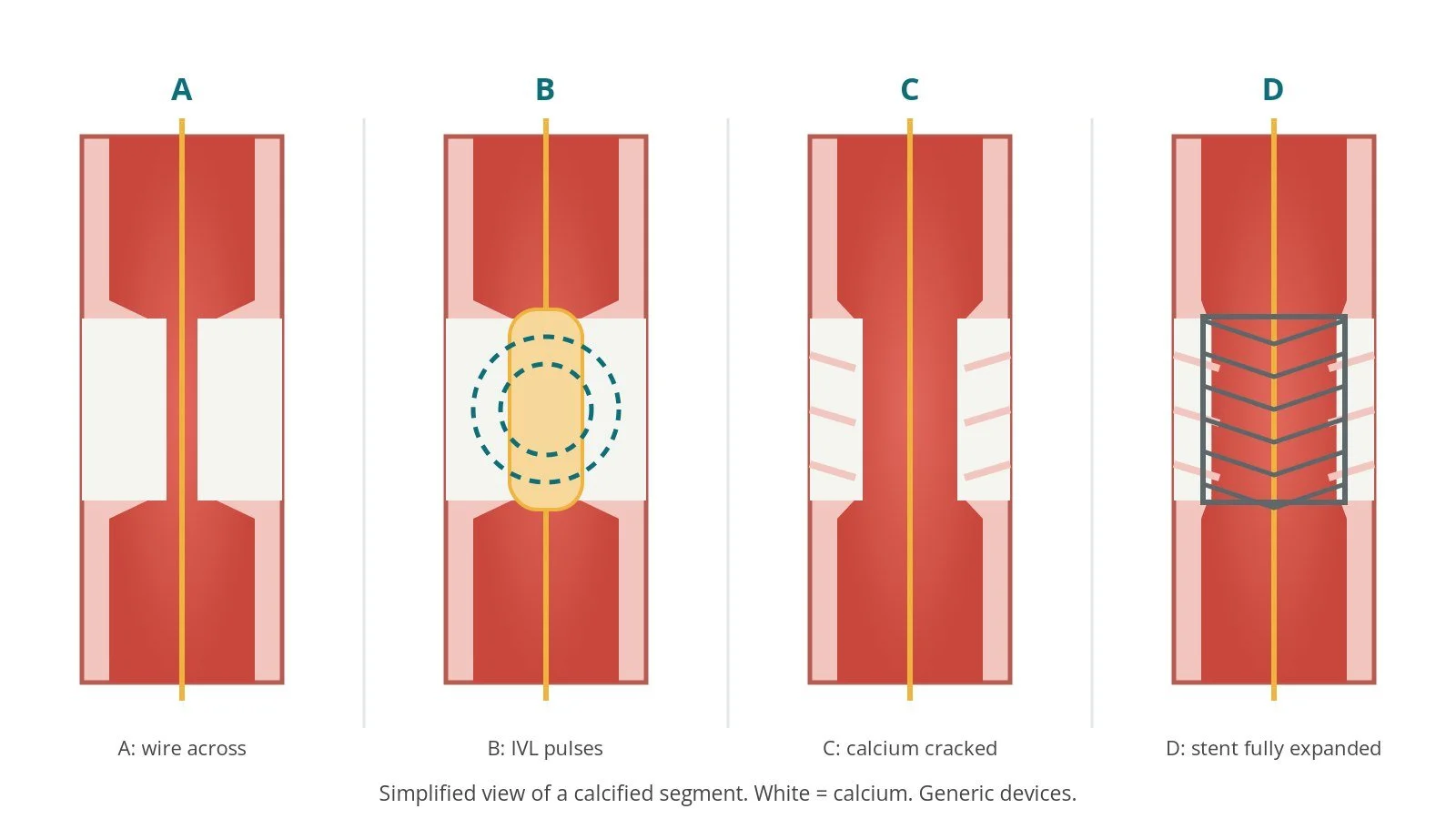 Four-panel diagram: a wire across a calcified narrowing, an IVL balloon delivering pulses, the calcium cracked with the artery opened, and a stent fully expanded