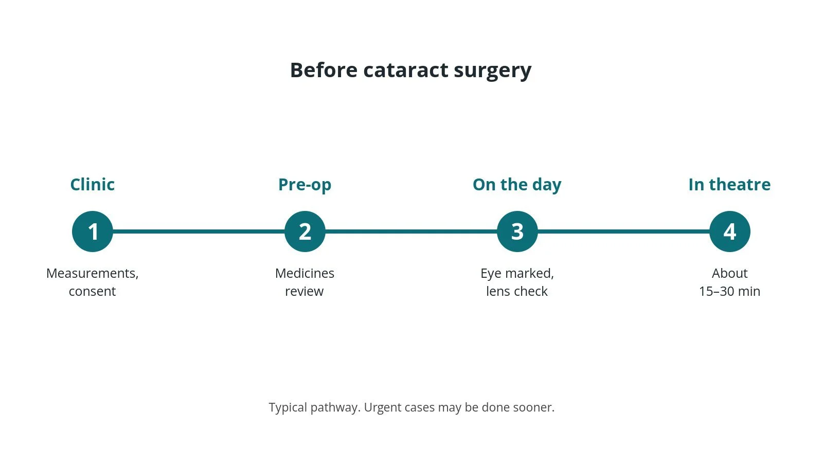 Timeline of the usual steps before cataract surgery: Clinic: Measurements, consent, Pre-op: Medicines review, On the day: Eye marked, lens check, In theatre: About 15–30 min