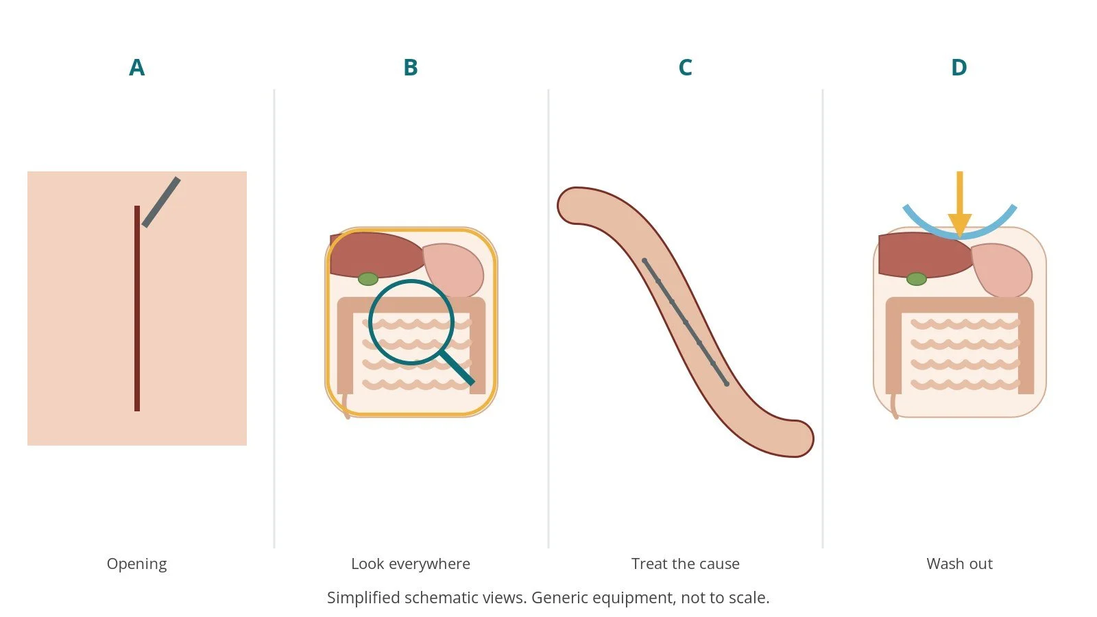 Four-panel schematic of exploratory laparotomy: opening, look everywhere, treat the cause, wash out