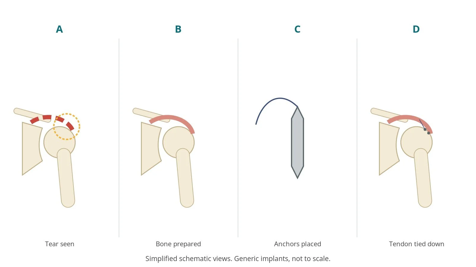 Four-panel schematic of rotator cuff repair: tear seen, bone prepared, anchors placed, tendon tied down