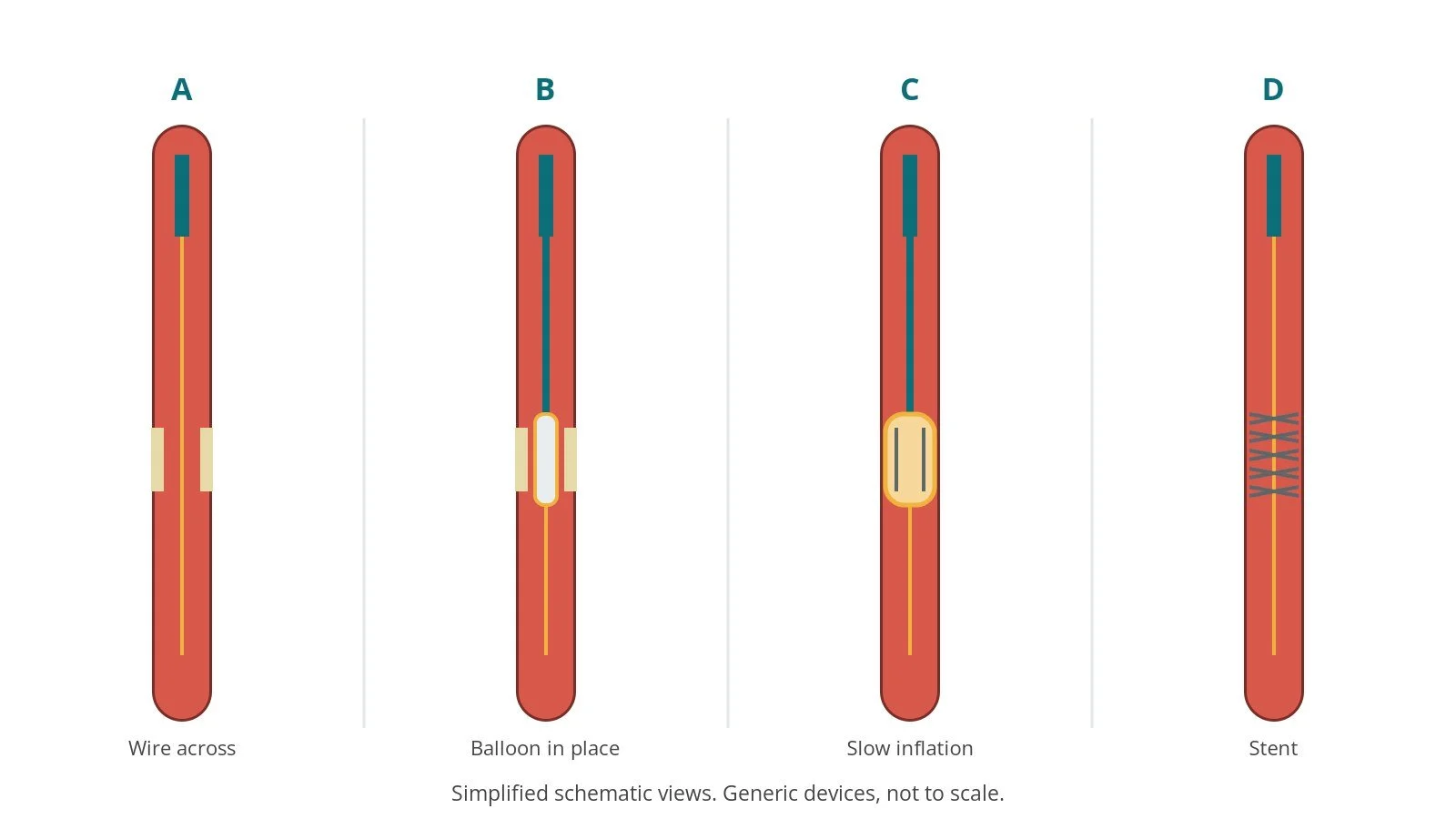 Four-panel schematic of cutting balloon angioplasty: wire across, balloon in place, slow inflation, stent