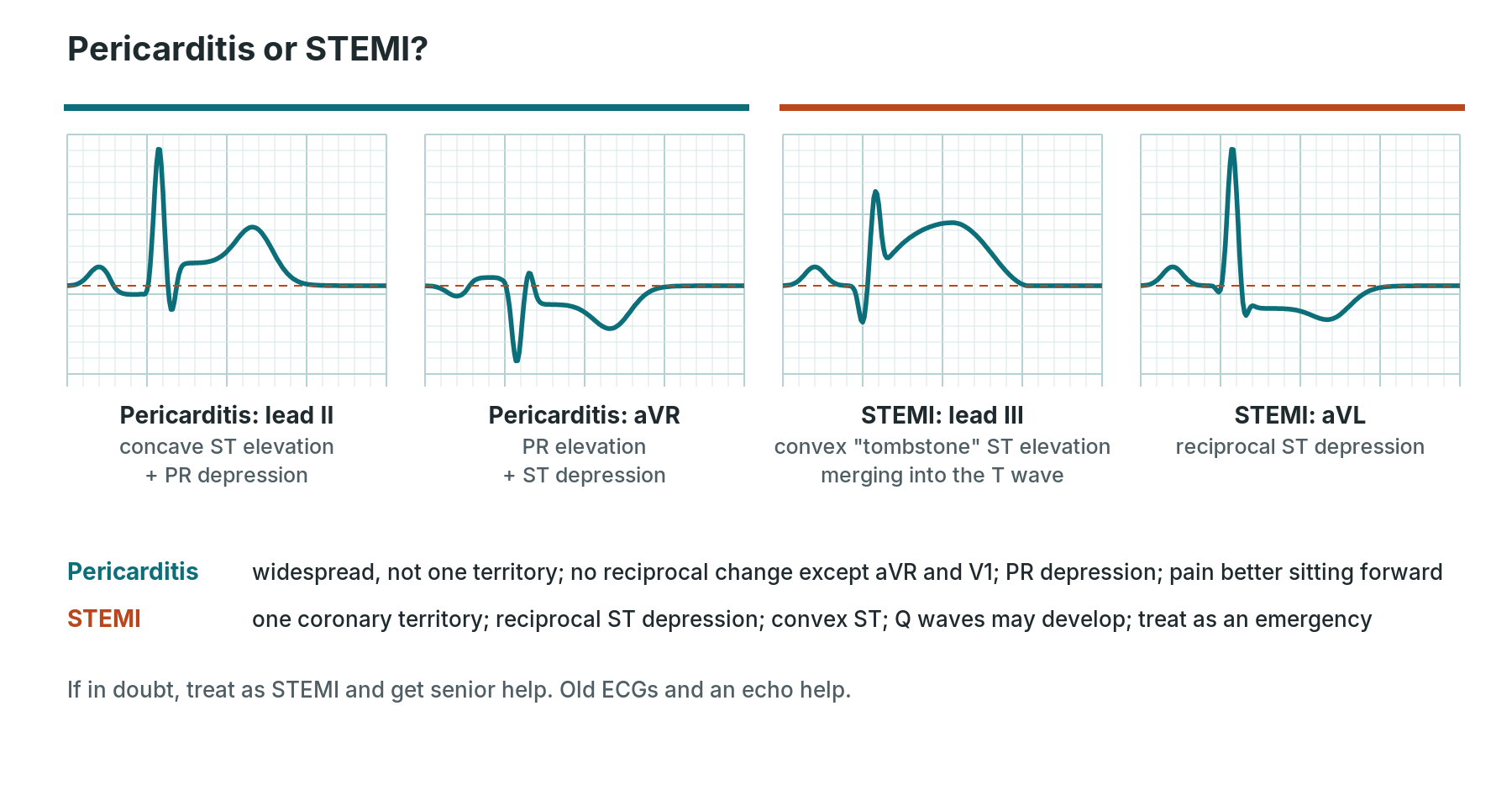 Comparison of pericarditis (concave ST elevation with PR depression, PR elevation in aVR) and STEMI (convex ST elevation with reciprocal depression)