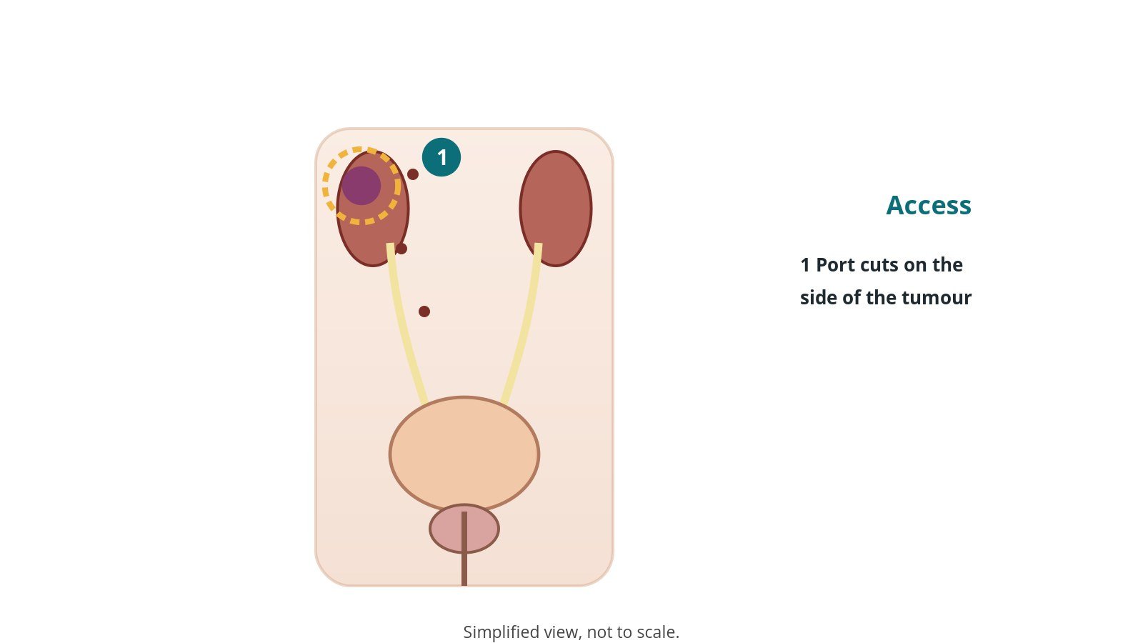 Diagram of the kidneys with a tumour in one kidney ringed and port sites near it