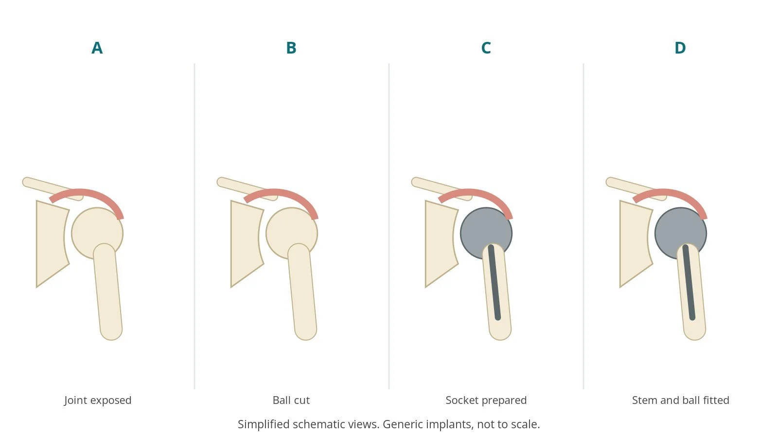 Four-panel schematic of shoulder replacement: joint exposed, ball cut, socket prepared, stem and ball fitted