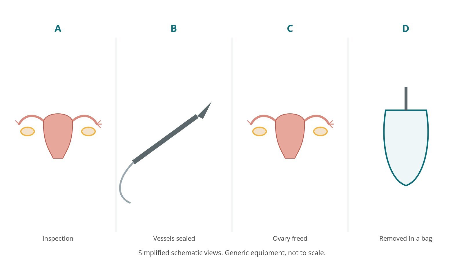 Four-panel schematic of oophorectomy: inspection, vessels sealed, ovary freed, removed in a bag