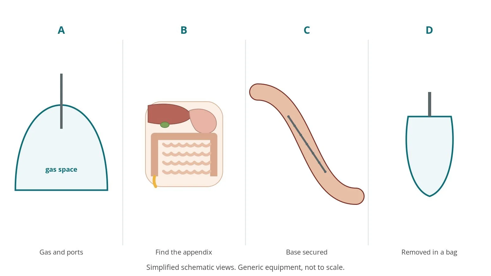 Four-panel schematic of lap appendectomy: gas and ports, find the appendix, base secured, removed in a bag
