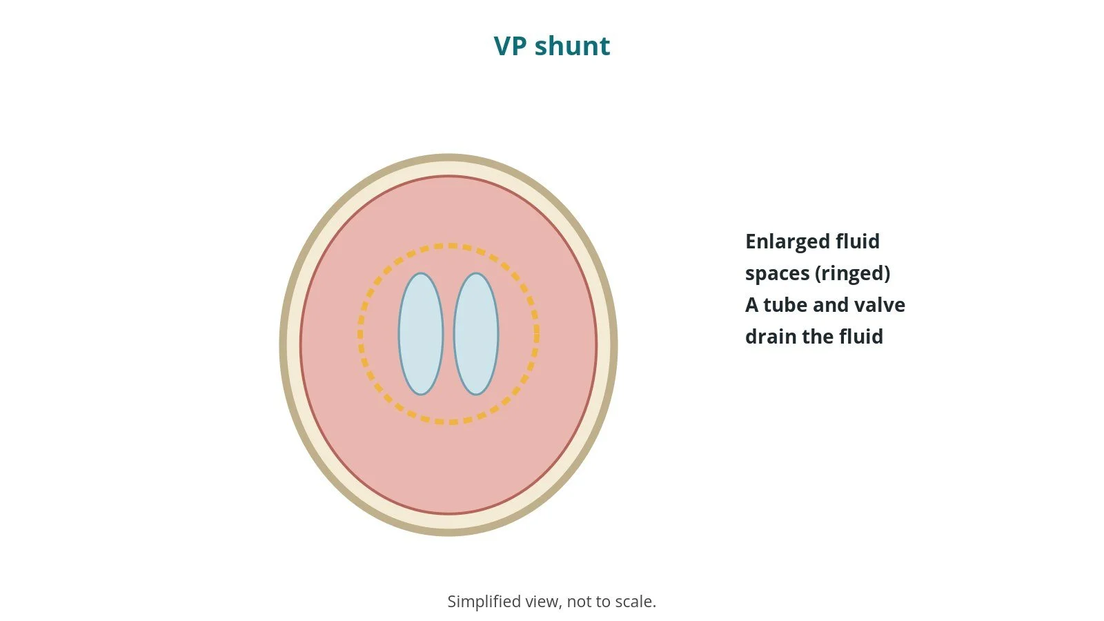 Diagram of the head with enlarged fluid spaces in the brain ringed