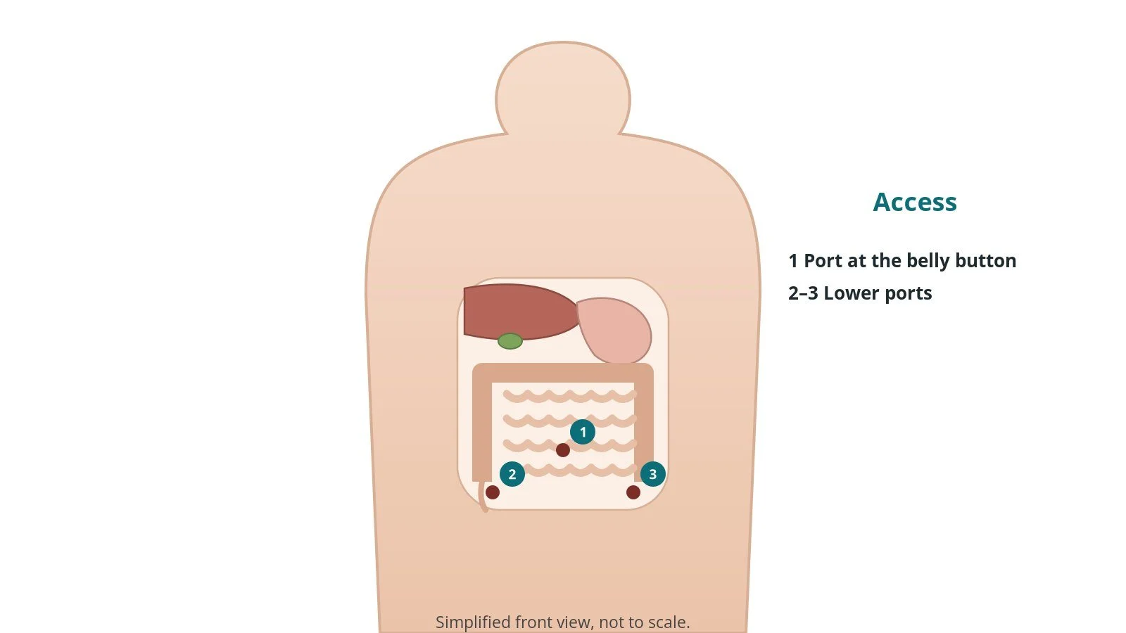 Front view of a patient showing a belly button port and two lower abdominal port sites