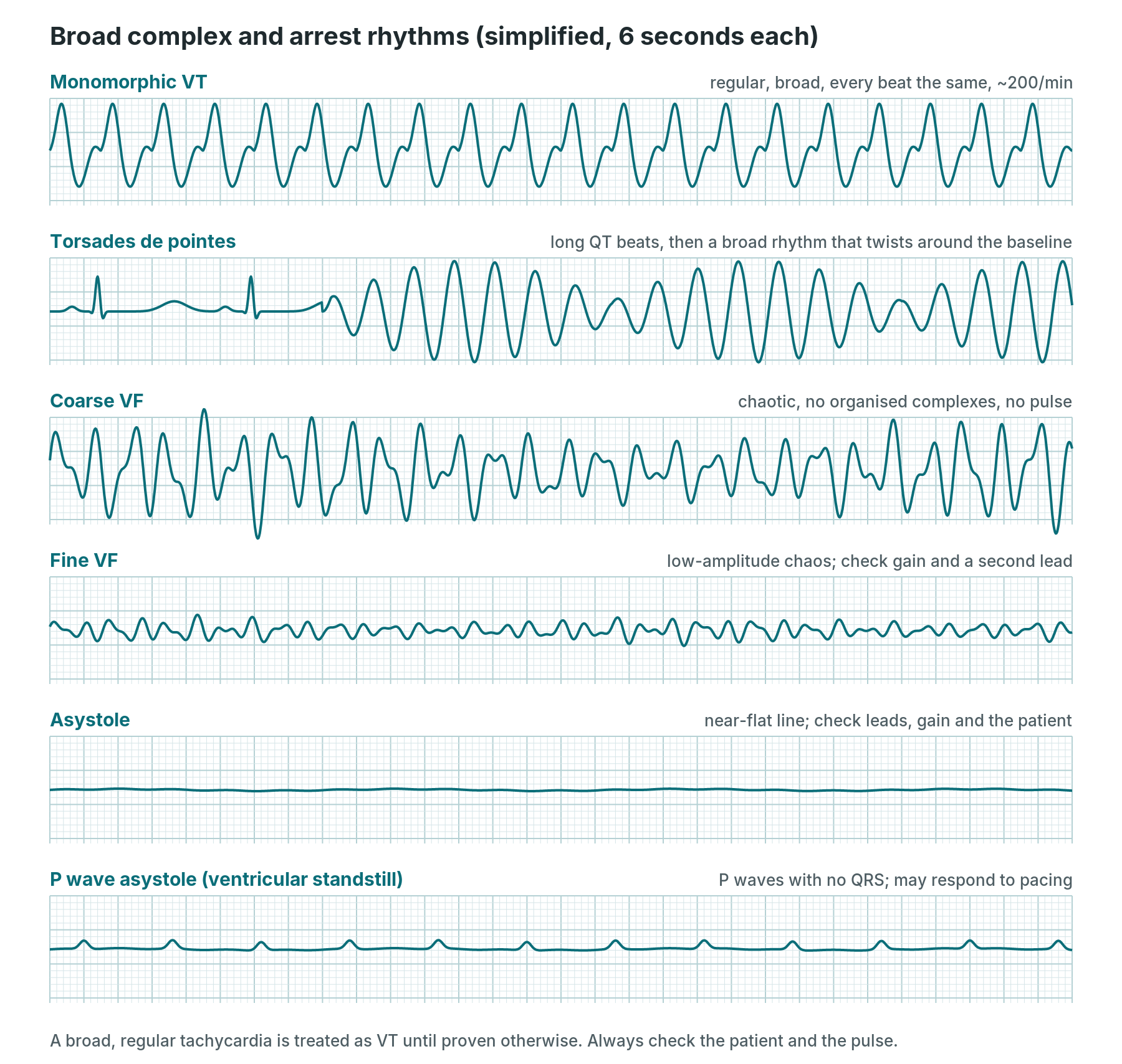 Simplified strips of monomorphic VT, torsades de pointes, coarse VF, fine VF, asystole and P wave asystole