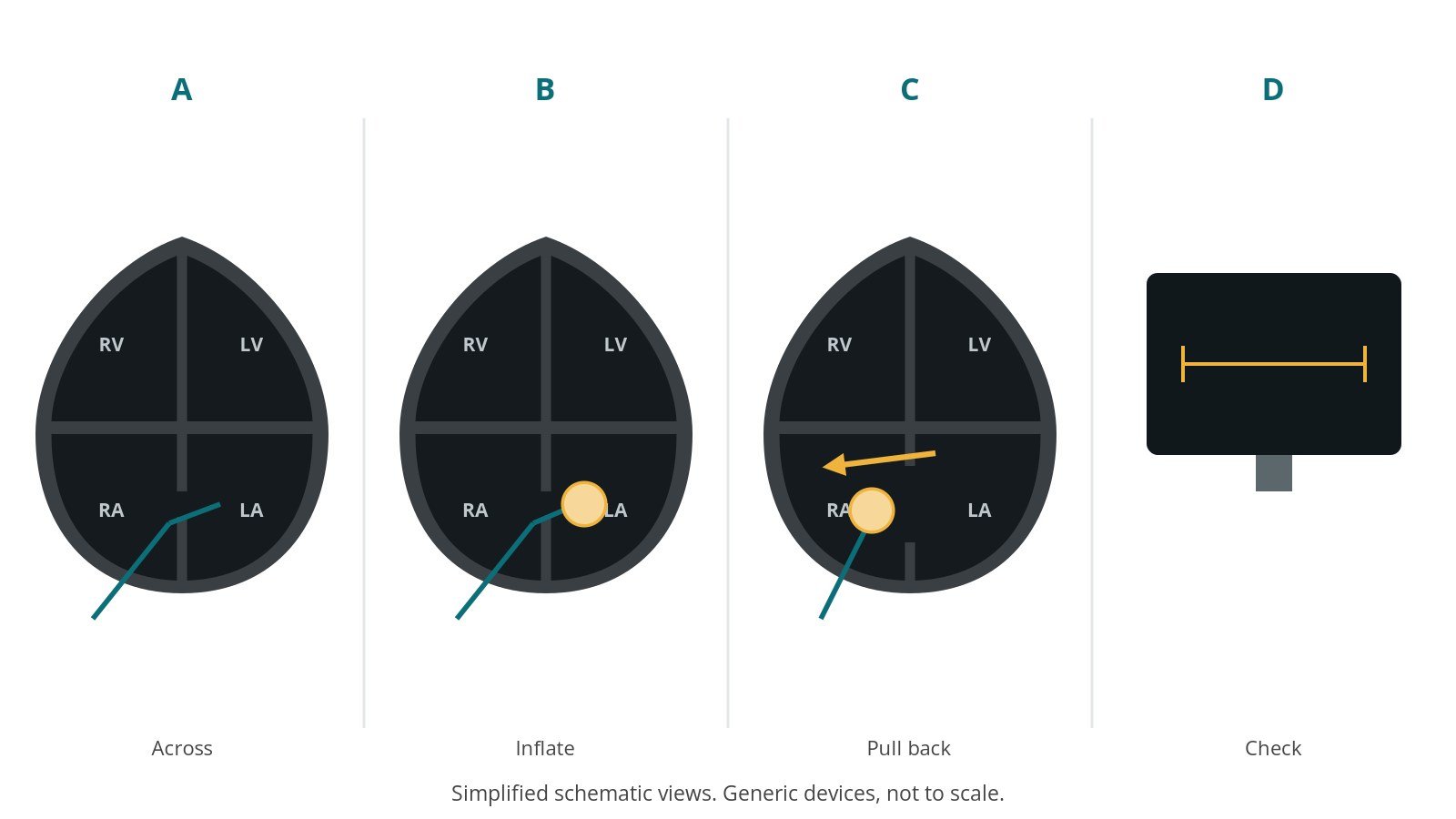 Four-panel schematic of atrial septostomy: across, inflate, pull back, check