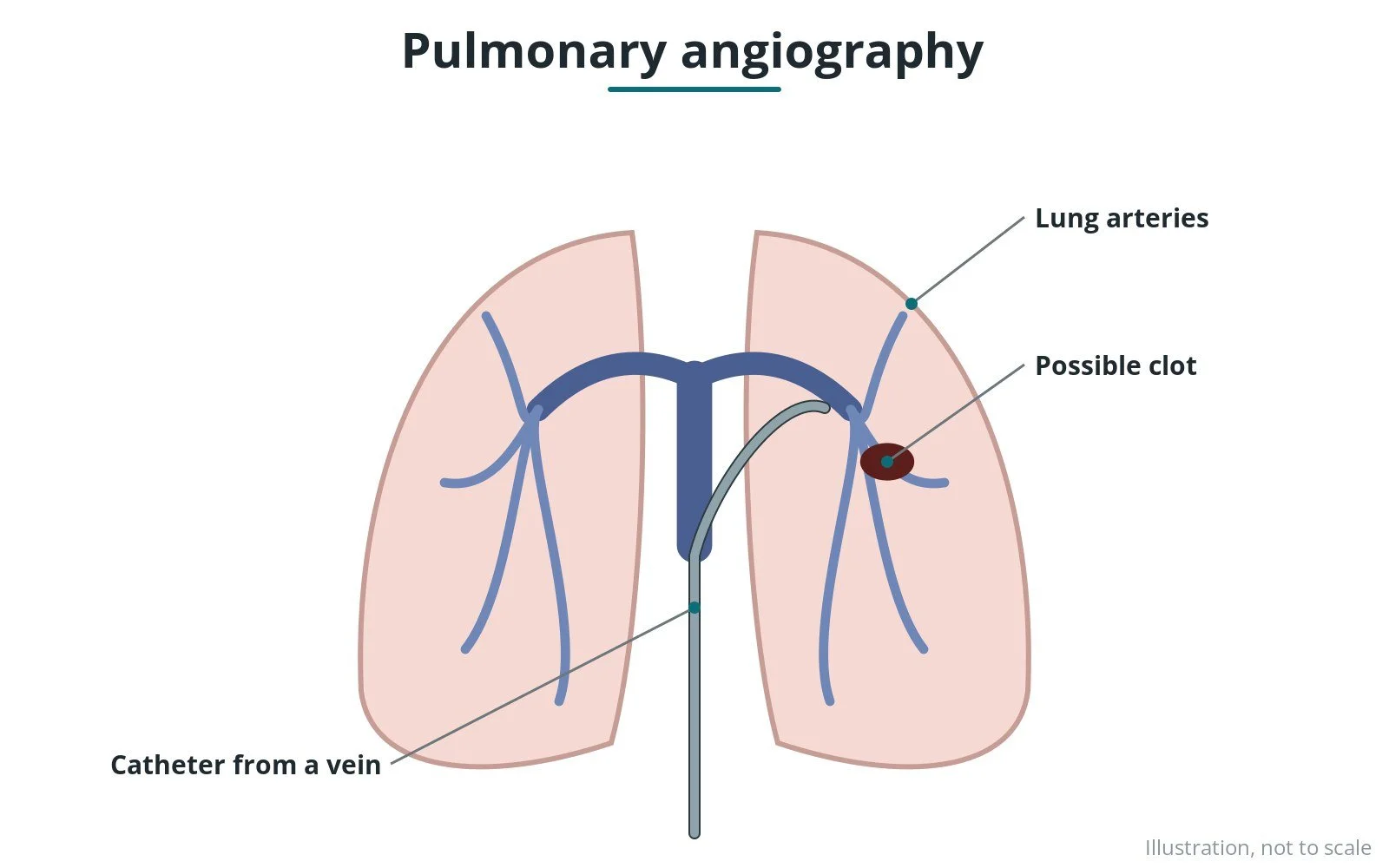 Diagram of a catheter through the right side of the heart into the lung arteries, filling them with contrast