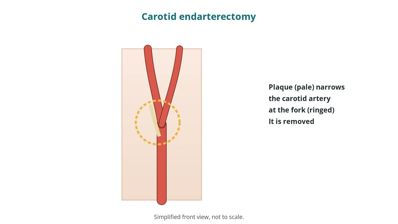 Diagram of the carotid artery in the neck dividing into two branches, with plaque at the fork ringed