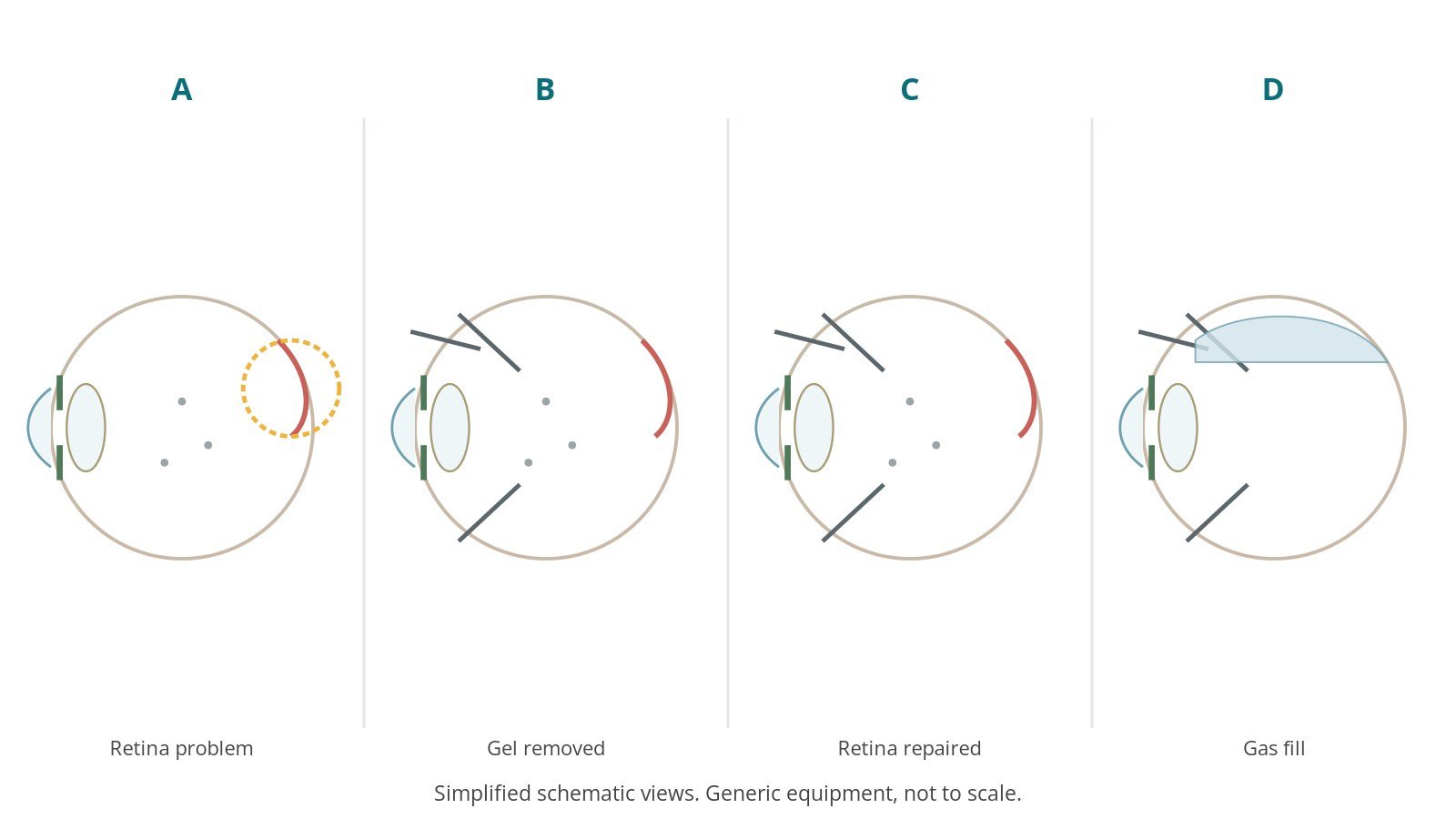 Four-panel schematic of vitrectomy: retina problem, gel removed, retina repaired, gas fill