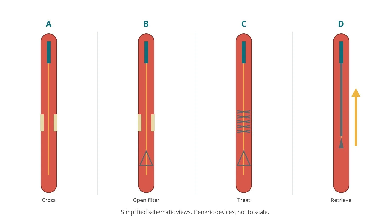 Four-panel schematic of distal protection: cross, open filter, treat, retrieve