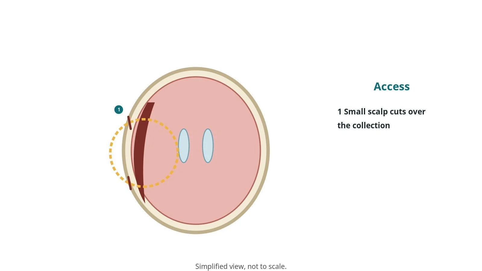 Diagram of the head from above with a crescent-shaped blood collection on one side and two small incision marks