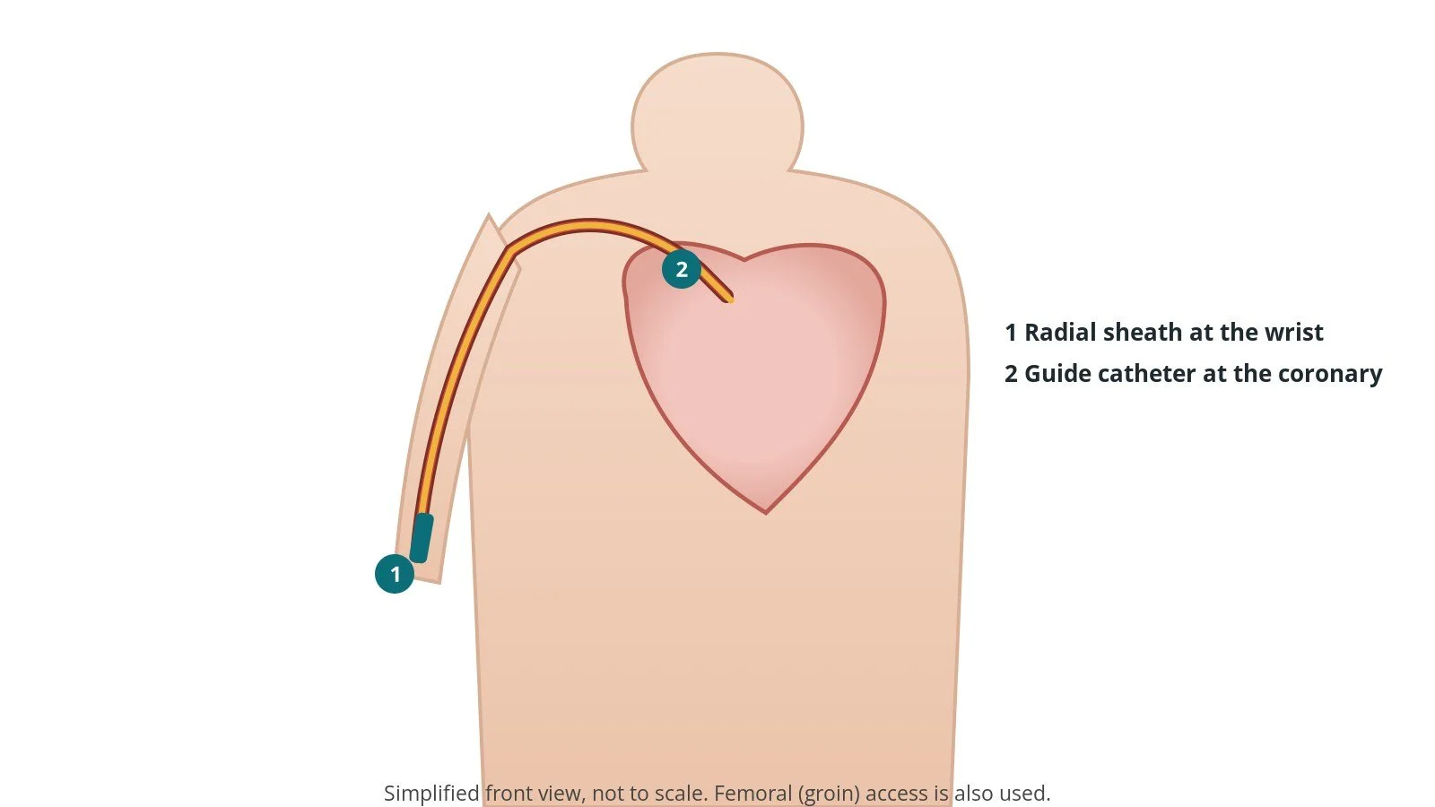 Front view of a patient showing a catheter from a sheath in the right wrist up the arm arteries to the heart