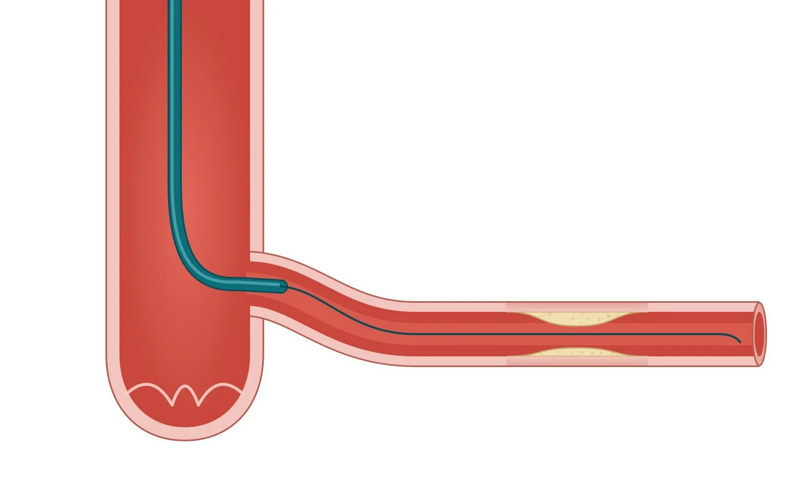 Diagram 3: guide catheter and guidewire crossing the narrowing
