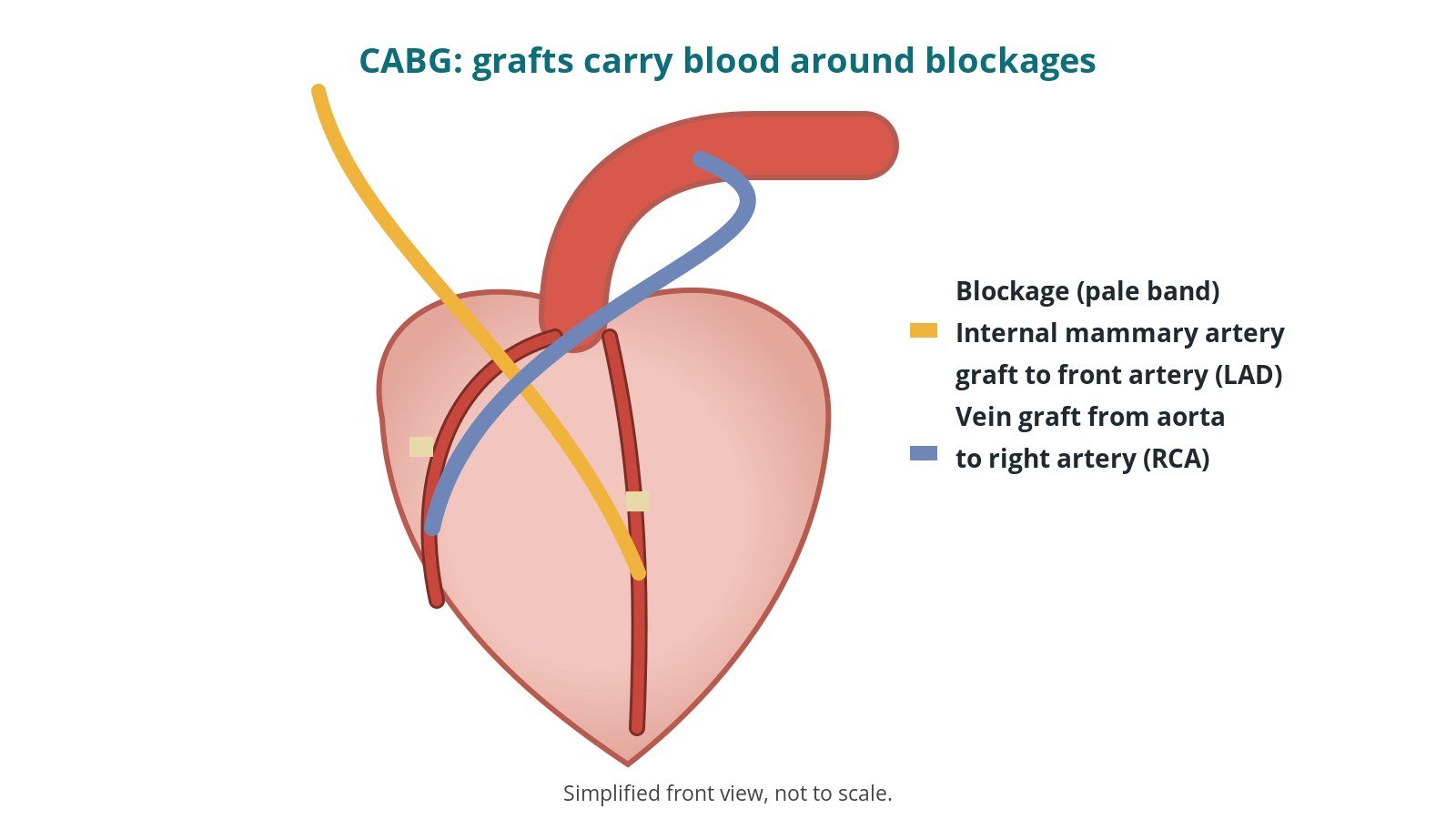 Diagram of the heart showing an internal mammary artery graft and a vein graft carrying blood around blockages in two heart arteries