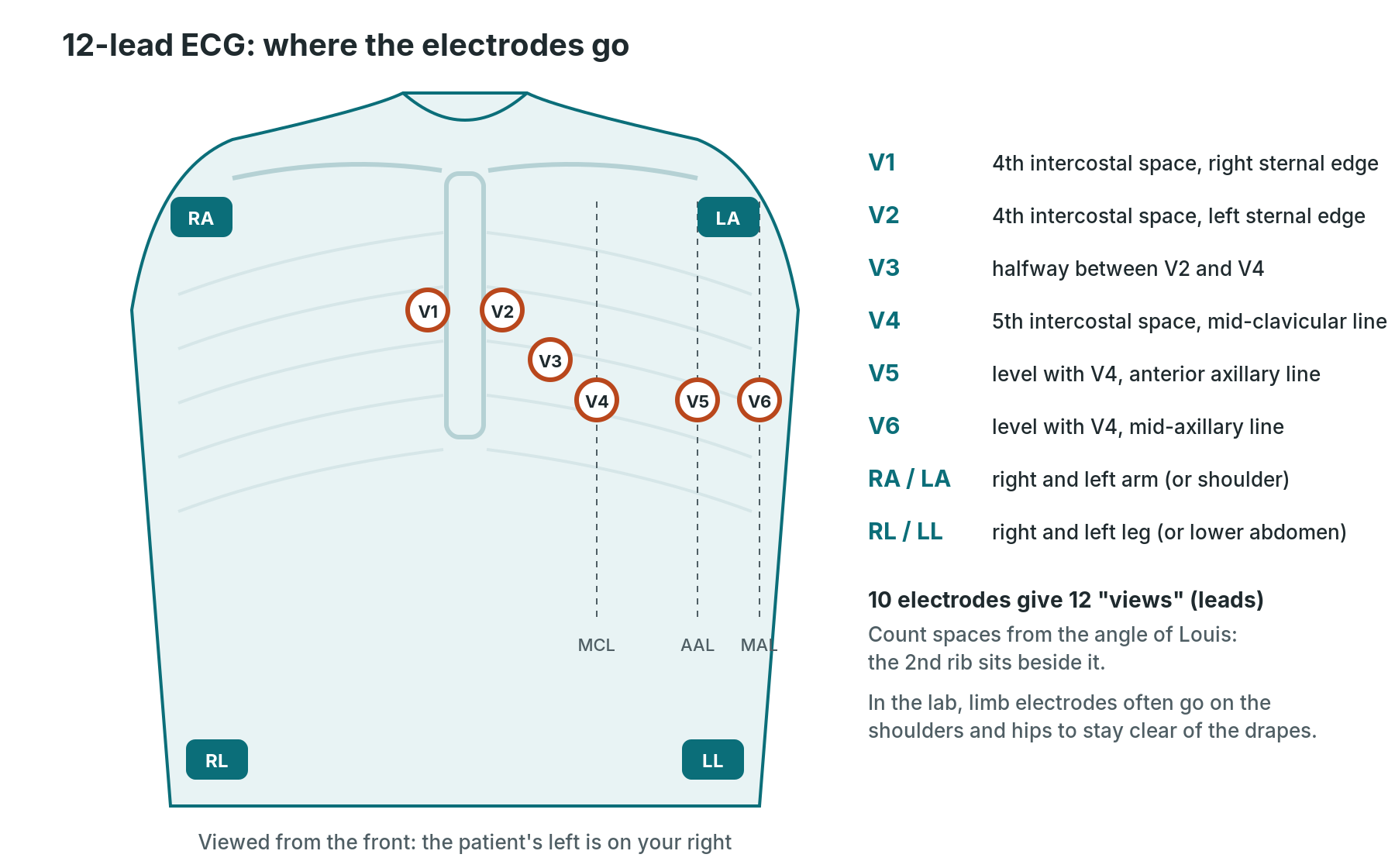 Diagram of 12-lead ECG electrode placement: V1 to V6 across the chest and four limb electrodes