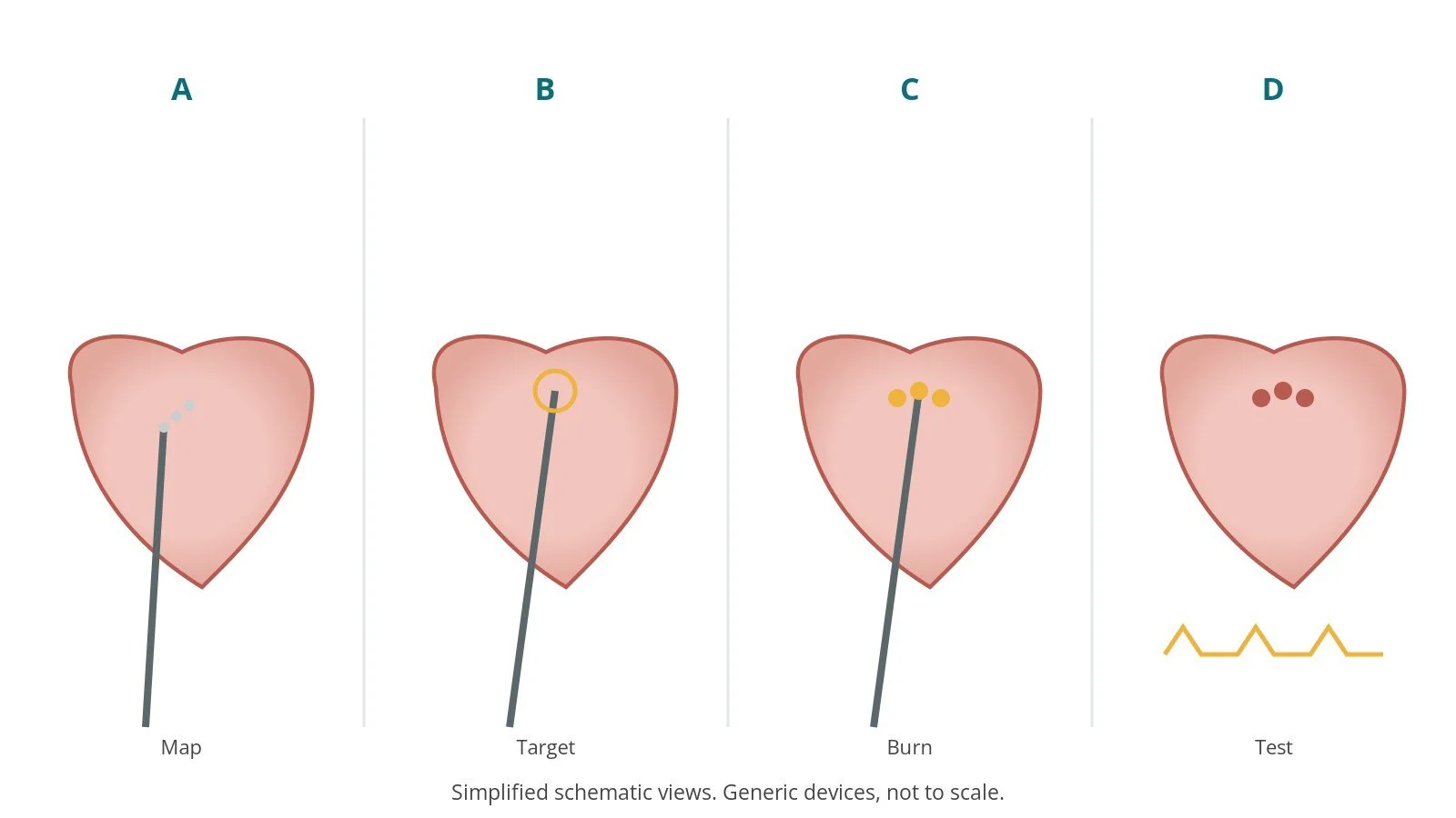 Four-panel schematic of radiofrequency ablation: map, target, burn, test