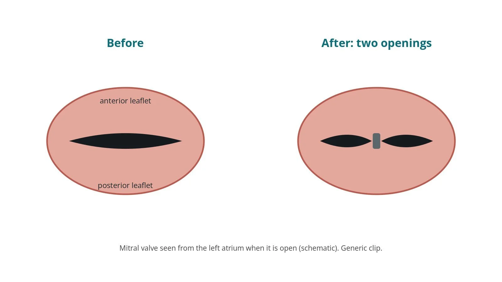 Diagram of the mitral valve seen from above after TEER, showing a double opening
