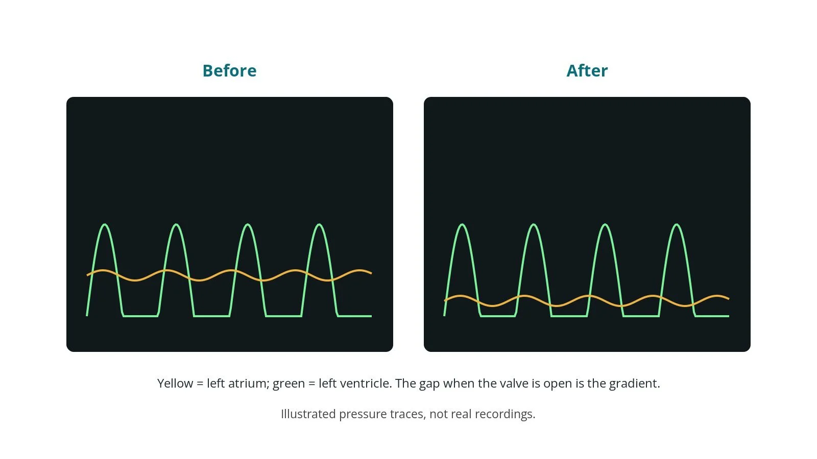 Illustrated pressure traces from the left atrium and left ventricle: a large gap before valvuloplasty and a small gap after