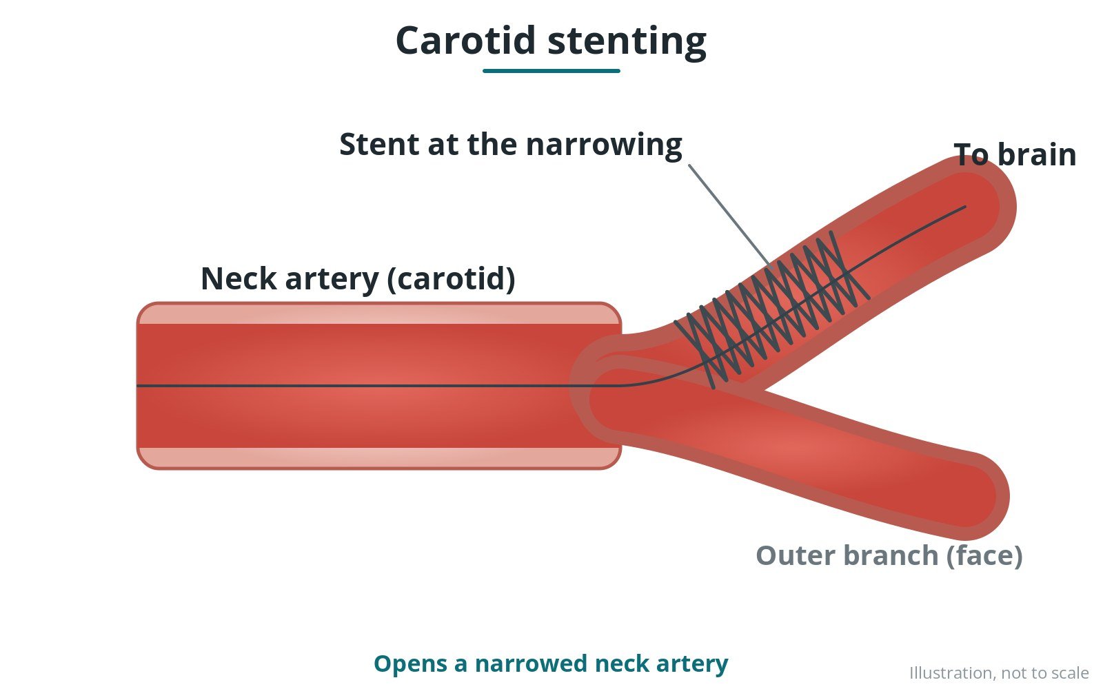 Diagram of a stent in a narrowed neck artery with a filter beyond it